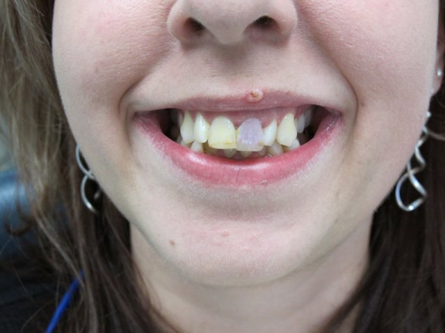 Internal Bleaching Before
